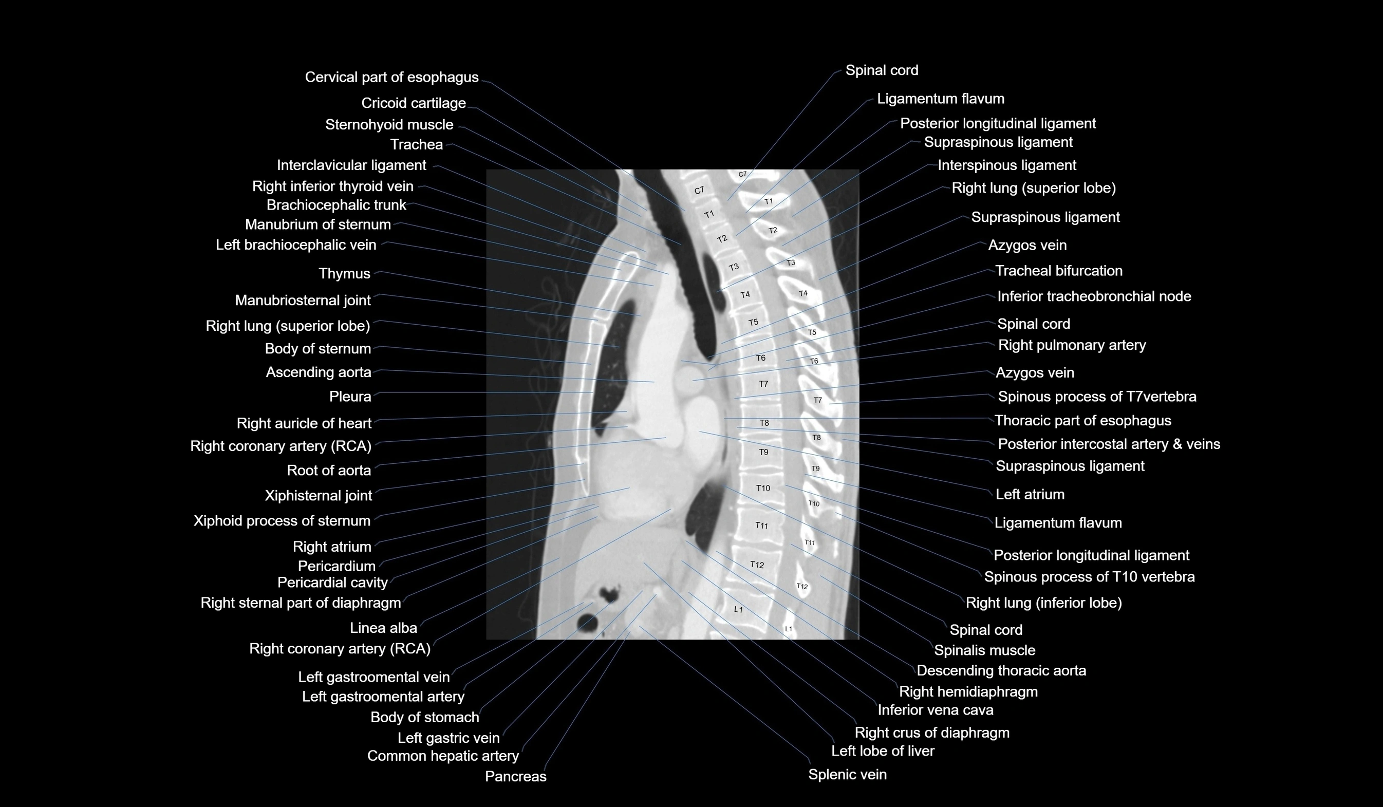CT chest (thorax) labelled sagittal cross sectional anatomy radiology image-00074.webp